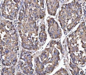 IHC staining of FFPE human liver cancer tissue with MFAP3 antibody. HIER: boil tissue sections in pH8 EDTA for 20 min and allow to cool before testing.