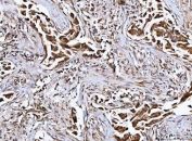 IHC staining of FFPE human breast cancer tissue with MFAP3 antibody. HIER: boil tissue sections in pH8 EDTA for 20 min and allow to cool before testing.