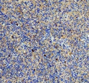 IHC staining of FFPE human glioma tissue with NPTXR antibody. HIER: boil tissue sections in pH8 EDTA for 20 min and allow to cool before testing.