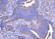 IHC staining of FFPE human colorectal adenocarcinoma tissue with NTN3 antibody. HIER: boil tissue sections in pH8 EDTA for 20 min and allow to cool before testing.