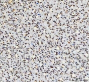 IHC staining of FFPE human glioma tissue with Aryl Hydrocarbon Receptor Repressor antibody. HIER: boil tissue sections in pH8 EDTA for 20 min and allow to cool before testing.