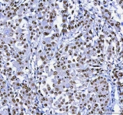 IHC staining of FFPE human lung cancer tissue with Aryl Hydrocarbon Receptor Repressor antibody. HIER: boil tissue sections in pH8 EDTA for 20 min and allow to cool before testing.