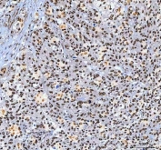 IHC staining of FFPE human bladder urothelial carcinoma tissue with Aryl Hydrocarbon Receptor Repressor antibody. HIER: boil tissue sections in pH8 EDTA for 20 min and allow to cool before testing.