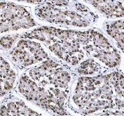 IHC staining of FFPE human liver cancer tissue with Aryl Hydrocarbon Receptor Repressor antibody. HIER: boil tissue sections in pH8 EDTA for 20 min and allow to cool before testing.
