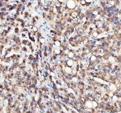IHC staining of FFPE human liver cancer tissue with Insulin-induced gene 1 antibody. HIER: boil tissue sections in pH8 EDTA for 20 min and allow to cool before testing.