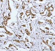 IHC staining of FFPE human breast cancer tissue with PSIP1 antibody. HIER: boil tissue sections in pH8 EDTA for 20 min and allow to cool before testing.