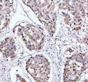 IHC staining of FFPE human liver cancer tissue with PSIP1 antibody. HIER: boil tissue sections in pH8 EDTA for 20 min and allow to cool before testing.