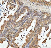 IHC staining of FFPE human ovarian cancer tissue with PSIP1 antibody. HIER: boil tissue sections in pH8 EDTA for 20 min and allow to cool before testing.