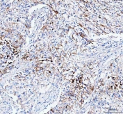 IHC staining of FFPE human lung cancer tissue with Paralemmin antibody. HIER: boil tissue sections in pH8 EDTA for 20 min and allow to cool before testing.