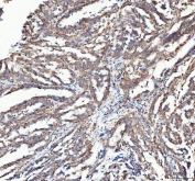 IHC staining of FFPE human ovarian serous adenocarcinoma tissue with ATG7 antibody. HIER: boil tissue sections in pH8 EDTA for 20 min and allow to cool before testing.