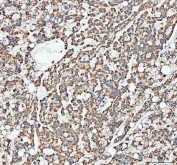 IHC staining of FFPE human liver cancer tissue with ATG7 antibody. HIER: boil tissue sections in pH8 EDTA for 20 min and allow to cool before testing.