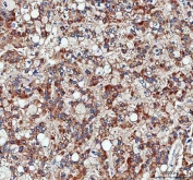 IHC staining of FFPE human liver cancer tissue with Pyruvate Carboxylase antibody. HIER: boil tissue sections in pH8 EDTA for 20 min and allow to cool before testing.