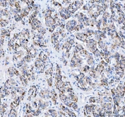 IHC staining of FFPE human lung adenocarcinoma tissue with Pyruvate Carboxylase antibody. HIER: boil tissue sections in pH8 EDTA for 20 min and allow to cool before testing.