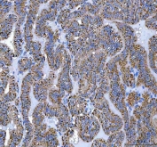 IHC staining of FFPE human thyroid cancer tissue with ATP5F1D antibody. HIER: boil tissue sections in pH8 EDTA for 20 min and allow to cool before testing.