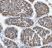 IHC staining of FFPE human liver cancer tissue with ATP5F1D antibody. HIER: boil tissue sections in pH8 EDTA for 20 min and allow to cool before testing.