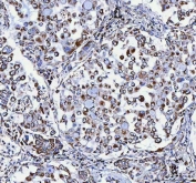 IHC staining of FFPE human lung cancer tissue with ATP5F1D antibody. HIER: boil tissue sections in pH8 EDTA for 20 min and allow to cool before testing.