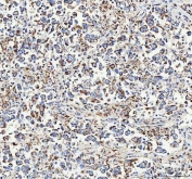 IHC staining of FFPE human testicular germ cell tumor tissue with ATP5F1D antibody. HIER: boil tissue sections in pH8 EDTA for 20 min and allow to cool before testing.