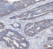 IHC staining of FFPE human colorectal adenocarcinoma tissue with ATP5F1D antibody. HIER: boil tissue sections in pH8 EDTA for 20 min and allow to cool before testing.