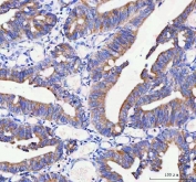 IHC staining of FFPE human rectum adenocarcinoma tissue with IDUA antibody. HIER: boil tissue sections in pH8 EDTA for 20 min and allow to cool before testing.