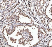 IHC staining of FFPE human thyroid cancer tissue with Matrin 3 antibody. HIER: boil tissue sections in pH8 EDTA for 20 min and allow to cool before testing.