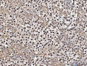 IHC staining of FFPE human testicular germ cell tumor tissue with Matrin 3 antibody. HIER: boil tissue sections in pH8 EDTA for 20 min and allow to cool before testing.