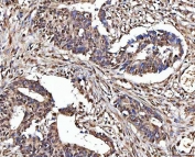 IHC staining of FFPE human rectum adenocarcinoma tissue with Matrin 3 antibody. HIER: boil tissue sections in pH8 EDTA for 20 min and allow to cool before testing.