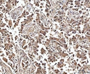 IHC staining of FFPE human breast cancer tissue with Matrin 3 antibody. HIER: boil tissue sections in pH8 EDTA for 20 min and allow to cool before testing.