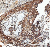 IHC staining of FFPE human esophageal squamous carcinoma tissue with IDH3G antibody. HIER: boil tissue sections in pH8 EDTA for 20 min and allow to cool before testing.
