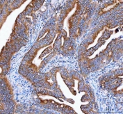 IHC staining of FFPE human rectum adenocarcinoma tissue with IDH3G antibody. HIER: boil tissue sections in pH8 EDTA for 20 min and allow to cool before testing.