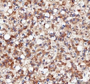 IHC staining of FFPE human liver cancer tissue with IDH3G antibody. HIER: boil tissue sections in pH8 EDTA for 20 min and allow to cool before testing.
