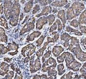 IHC staining of FFPE human liver cancer tissue with DAPK1 antibody. HIER: boil tissue sections in pH8 EDTA for 20 min and allow to cool before testing.