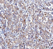 IHC staining of FFPE human lung cancer tissue with Amyloid-like protein 2 antibody. HIER: boil tissue sections in pH8 EDTA for 20 min and allow to cool before testing.
