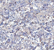 IHC staining of FFPE human testicular germ cell tumor tissue with Amyloid-like protein 2 antibody. HIER: boil tissue sections in pH8 EDTA for 20 min and allow to cool before testing.