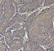 IHC staining of FFPE human liver cancer tissue with RPL18 antibody. HIER: boil tissue sections in pH8 EDTA for 20 min and allow to cool before testing.