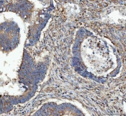 IHC staining of FFPE human rectum adenocarcinoma tissue with RPL18 antibody. HIER: boil tissue sections in pH8 EDTA for 20 min and allow to cool before testing.