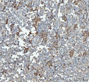 IHC staining of FFPE human testicular germ cell tumor tissue with RPL18 antibody. HIER: boil tissue sections in pH8 EDTA for 20 min and allow to cool before testing.
