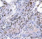 IHC staining of FFPE human esophageal squamous carcinoma tissue with IFFO1 antibody. HIER: boil tissue sections in pH8 EDTA for 20 min and allow to cool before testing.