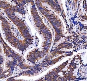 IHC staining of FFPE human colorectal adenocarcinoma tissue with MTF1 antibody. HIER: boil tissue sections in pH8 EDTA for 20 min and allow to cool before testing.