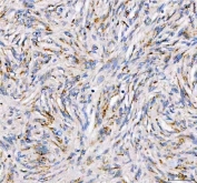 IHC staining of FFPE human meningioma tissue with PDK3 antibody. HIER: boil tissue sections in pH8 EDTA for 20 min and allow to cool before testing.