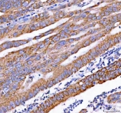 IHC staining of FFPE human rectum adenocarcinoma tissue with PDK3 antibody. HIER: boil tissue sections in pH8 EDTA for 20 min and allow to cool before testing.