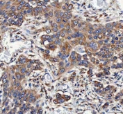 IHC staining of FFPE human esophageal squamous carcinoma tissue with Mitofilin antibody. HIER: boil tissue sections in pH8 EDTA for 20 min and allow to cool before testing.