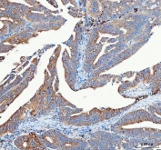 IHC staining of FFPE human rectum adenocarcinoma tissue with Mitofilin antibody. HIER: boil tissue sections in pH8 EDTA for 20 min and allow to cool before testing.