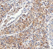 IHC staining of FFPE human lung cancer tissue with Mitofilin antibody. HIER: boil tissue sections in pH8 EDTA for 20 min and allow to cool before testing.