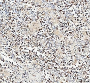 IHC staining of FFPE human testicular germ cell tumor tissue with Mitofilin antibody. HIER: boil tissue sections in pH8 EDTA for 20 min and allow to cool before testing.