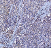 IHC staining of FFPE human bladder urothelial carcinoma tissue with LGI4 antibody. HIER: boil tissue sections in pH8 EDTA for 20 min and allow to cool before testing.