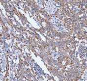 IHC staining of FFPE human bladder urothelial carcinoma tissue with Pellino-3 antibody. HIER: boil tissue sections in pH8 EDTA for 20 min and allow to cool before testing.