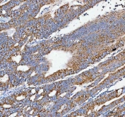 IHC staining of FFPE human rectum adenocarcinoma tissue with Pellino-3 antibody. HIER: boil tissue sections in pH8 EDTA for 20 min and allow to cool before testing.