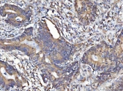 IHC staining of FFPE human colorectal adenocarcinoma tissue with MOSPD2 antibody. HIER: boil tissue sections in pH8 EDTA for 20 min and allow to cool before testing.