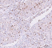 IHC staining of FFPE human lung cancer tissue with Josephin 2 antibody. HIER: boil tissue sections in pH8 EDTA for 20 min and allow to cool before testing.