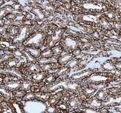 IHC staining of FFPE human thyroid papillary carcinoma tissue with Josephin 2 antibody. HIER: boil tissue sections in pH8 EDTA for 20 min and allow to cool before testing.